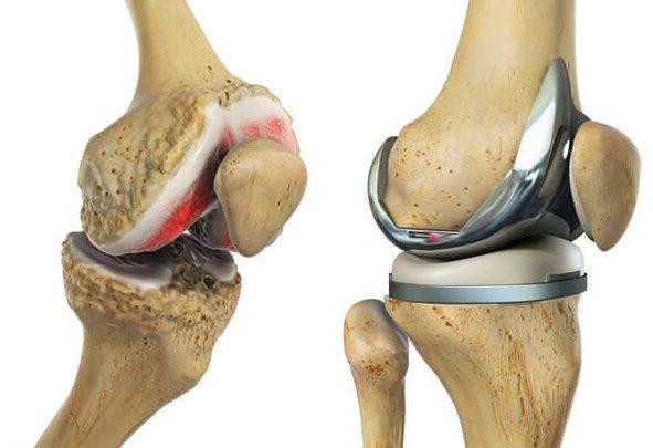 Knee Replacement